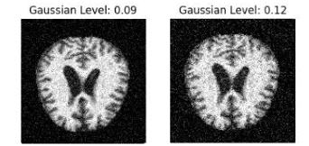 Can AI see Alzheimer's before Symptoms appear?